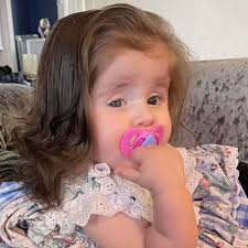 Girl, 2, tears her hair out at roots and eats a dummy a day due to rare  condition