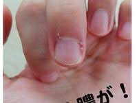 爪囲炎に効く市販薬はリンデロン 薬なしでも治る治療法を公開 カラダメグリズム part 5 爪 ほくろ除去クリーム オロナイン