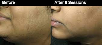 Laser hair removal for asian skin is now available in leeds, altrincham, bury, liverpool and london. Face Laser Hair Removal In Atlanta Ga Wifh
