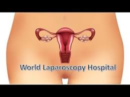 Laparoscopic Surgery For Dermoid Ovarian Cyst Ovarian Cyst Dermoid Ovarian Cyst Ovarian Cyst Symptoms