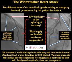 Widowmaker Heart Attack Explained By Cardiologist Myheart