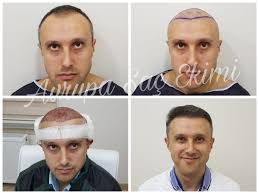 Asmed hair center koray erdoğan saç ekimi fiyatları greft başına 2 euro ile 2.5 euro arasında değişmekte. Avrupa Sac Ekimi Clinic In Turkey Treatment Cost And Verified Reviews Bookimed