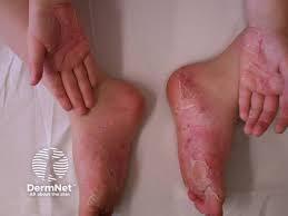 Image result for pompholyx soles of feet