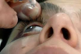 Ne confruntam cumva cu un alt caz în care ar fi trebuit făcute mai multe teste înainte de lansarea acestui deoarece chirurgia si operatia laser la ochi lasik a fost aprobată în 1998, peste 17 milioane de oameni din întreaga lume au avut această. Video Strabismul De Ce Apare Si Cum Se Poate Corecta Interviu Cu Dr Oftalmolog Oana Andrei Medlife