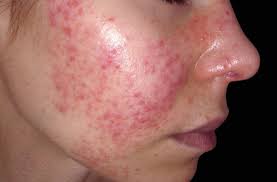 Subacute cutaneous lupus erythematosus (scle) is a clinically distinct form of cle that presents as a highly lesions below the waist are uncommon. Clinician Roundtable Improving Quality Of Life In Systemic Lupus Erythematosus Rheumatology Advisor