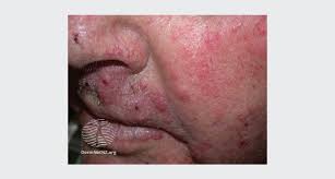 Image result for red rash face