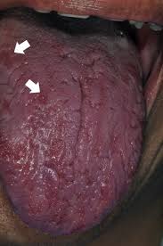 Image result for Fissured tongue