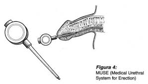 Image result for Intraurethral Alprostadil