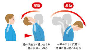 交通事故で起こるむち打ち症の正体は？ -その症状と治療法を解説!- |あやせ駅前整形外科・内科【公式】足立区 交通事故治療 巻き爪治療  リハビリテーション科 さん