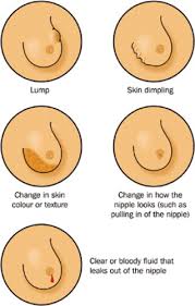 A new lump or thickening in your breast or armpit a change in size, shape or feel of your breast Signs And Symptoms Of Breast Cancer The Practice Nurse Role Practice Nursing