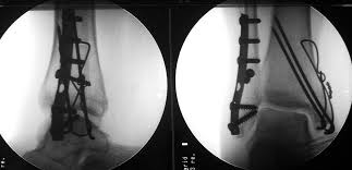 Rom=32 dorsiflexion, 45 plantar flexion. Bimalleolar Fracture Wikipedia