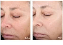 They're used to improve the chemical peels are used to remove damaged skin cells, revealing healthier skin underneath. Chemical Peels Grand Rapids Michigan Renewal Skin Spa