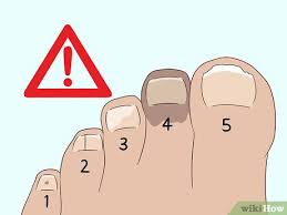 If you have a black toenail it could be a symptom of toenail fungus. 3 Easy Ways To Treat A Black Toenail Wikihow