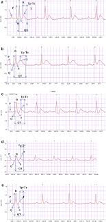 A Ecg Chart Of Normal Rat Showing Regular Ecg Normal