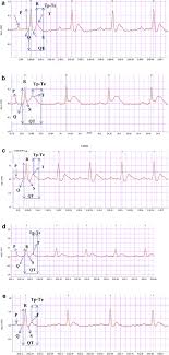 A Ecg Chart Of Normal Rat Showing Regular Ecg Normal