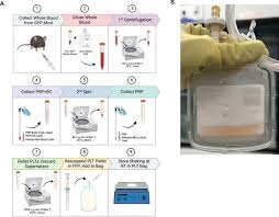 Image result for Platelet Transfusion