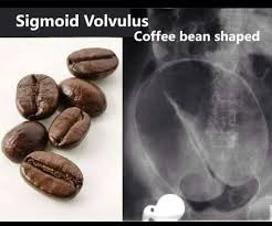 Sigmoid Volvulus Radiology Medical Knowledge Radiology Tech