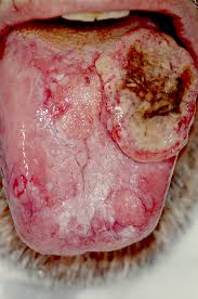 This growth further affects neighboring tissues. Head And Neck Cancer Wikipedia