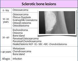 The Radiology Assistant Sclerotic Tumors