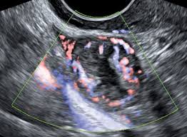 Image result for corpus luteum sonography)