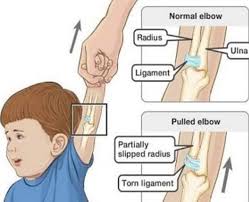 Image result for Radial Head Dislocation