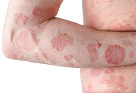 Image result for psoriasis