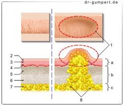 Lipom Am Kopf Wie Gefahrlich Ist Das