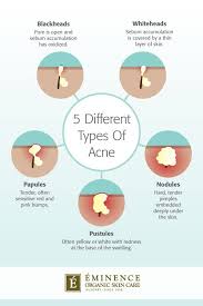 Types Of Acne The Differences Between Your Bumps And