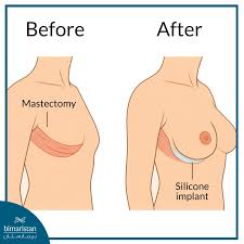 Image result for Mastectomy