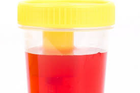 Keinginan untuk sering buang air kecil , tetapi dalam jumlah kecil. 10 Arti Warna Air Urine Terhadap Kesehatanmu Apakah Kamu Cukup Minum