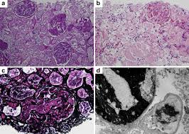 Share photos and videos, send messages and get updates. Thrombotic Microangiopathy In A Patient With Covid 19 Kidney International