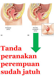 Kesakitan perut selepas bersalin sangat biasa. Tanda Peranakan Perempuan Sudah Jatuh Sifuli Terapi