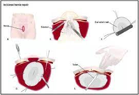 Incisional Hernia Repair Procedure Recovery Blood Tube Pain Complications Adults Time