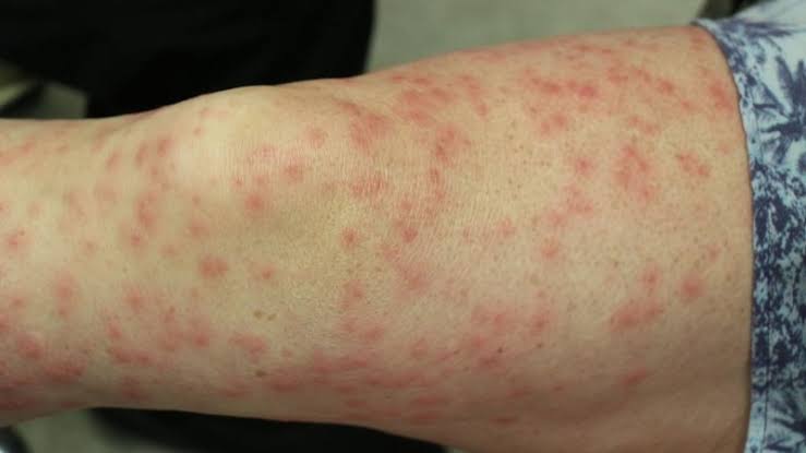 6 cách điều trị phát ban do nhiệt