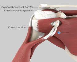 Unlike the other muscles in the anterior compartment of the arm, the biceps muscle crosses two joints, the shoulder joint and the elbow joint. Coracoid Block Latarjet Procedure Doctor Matthieu Meyer