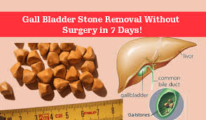 Are You Wondering How To Dissolve Gallstones Naturally Don T Worry Now Gall Bladder Stone Removal Without Surgery In 7 Gallbladder Gallbladder Stones Bladder