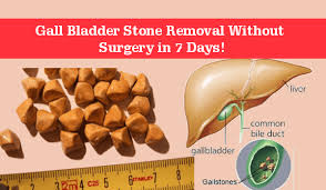 7 gallstones symptoms you need to know about. Are You Wondering How To Dissolve Gallstones Naturally Don T Worry Now Gall Bladder Stone Removal Without Surgery In 7 Gallbladder Gallbladder Stones Bladder