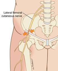 Entrapped Nerves Treated At The Peripheral Nerve Center At Mount Meralgia Paresthetica Peripheral Nerve Femoral Nerve
