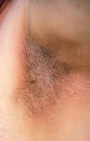 Itchy armpit rash is common in men and women both. Dermatologic Signs Of Systemic Disease