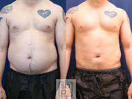 Image result for Liposuction