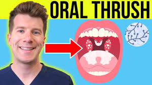 Image result for oral thrush symptoms roof of the mouth