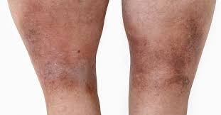 Image result for Pigment stains on the shin