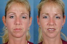 In the broadest sense, body modification has been practiced by adults and children of many cultures for hundreds, if not thousands, of years. Ear Pinning Otoplasty In Louisville Lexington Ky Caloaesthetics Plastic Surgery Center