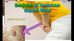 Orang yang aktiv seksual memiliki resiko terkena virus hpv penyebab penyakit kelamin, hampir 70% orang yang aktiv. Jerawat Di Kemaluan Wanita Sebelah Kiri Malaybubu