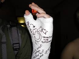 Image result for Radial Gutter Cast