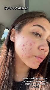 Avi Clear Laser Before and After