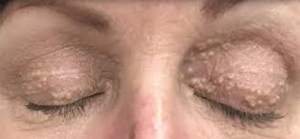 Image result for milium cyst on eyelid