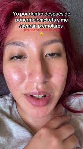 Experiencias con Brackets: Primer Día y Consejos