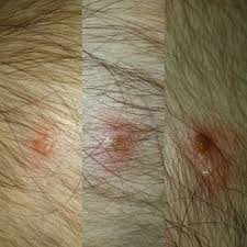 Image result for dry scabs on the head in children