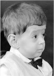 Cutis Laxa and Premature Aging Syndromes